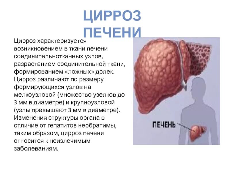 Цирроз печени цирроз печени. Кокпноузловоц некроз печени.