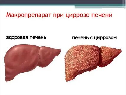 Печень плохая причины