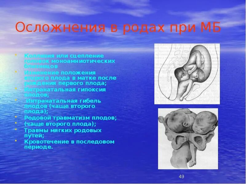 Осложнения родов при многоплодии. Осложнения в родах при многоплодии. 4 роды осложнения