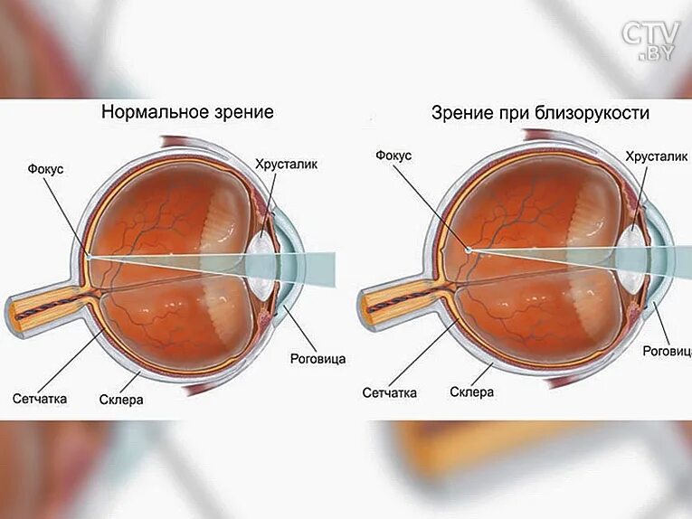 Причины испорченного зрения. От чего ухудшается зрение. Как портится зрение. Из чего портится зрение.