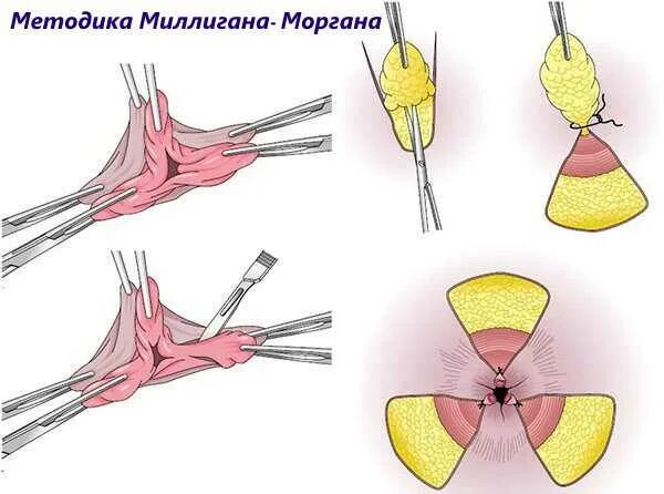 Операция Миллигана-Моргана геморроидэктомия. Миллигана Моргана операция геморрой. Операция геморроидэктомия по Миллигану Моргану. Геморроидэктомия по миллиган Моргану. Стул после операции на геморрой