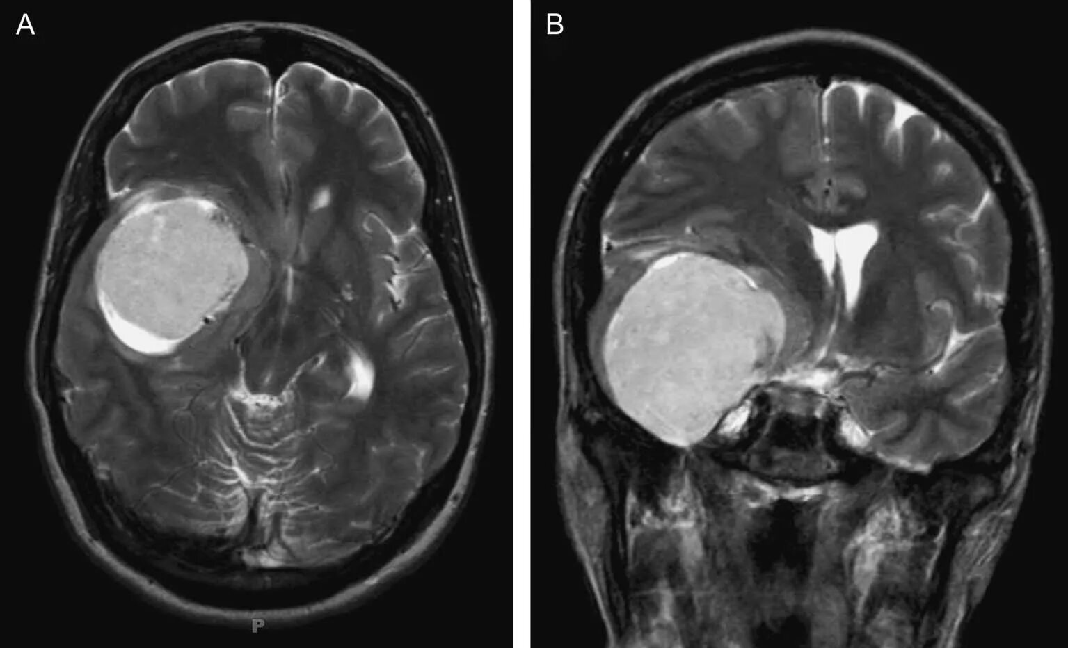 Доброкачественная опухоль головного мозга мрт. Мрт головного мозга опухоль. Менингиома головного мозга снимок. Перивентрикулярная киста головного мозга. Опухоль головного мозга отек