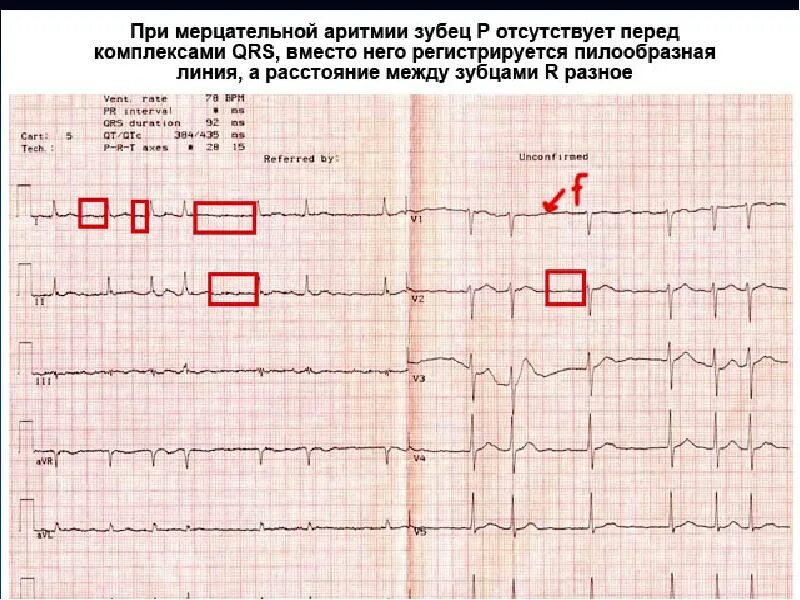 Кардиограмма сердца расшифровка норма у взрослых. Экг патологии расшифровка таблица. экг расшифровка для студентов норма и патология. расшифровка экг показатели нормы таблица взрослых синусовый. экг норма расшифровка кардиограммы показатели у взрослых.