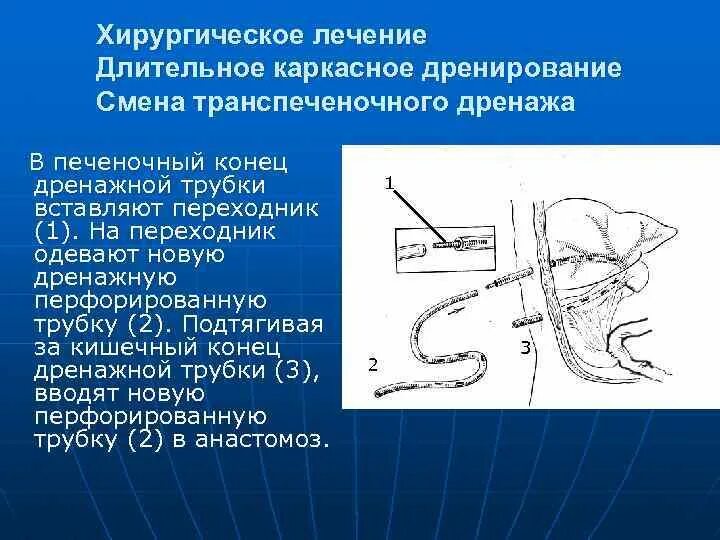 Дренирование является методом. Дренирование холедоза. дренирование по керу рентген. остеоперфорация операция. прадери смиту транспеченочный дренаж.