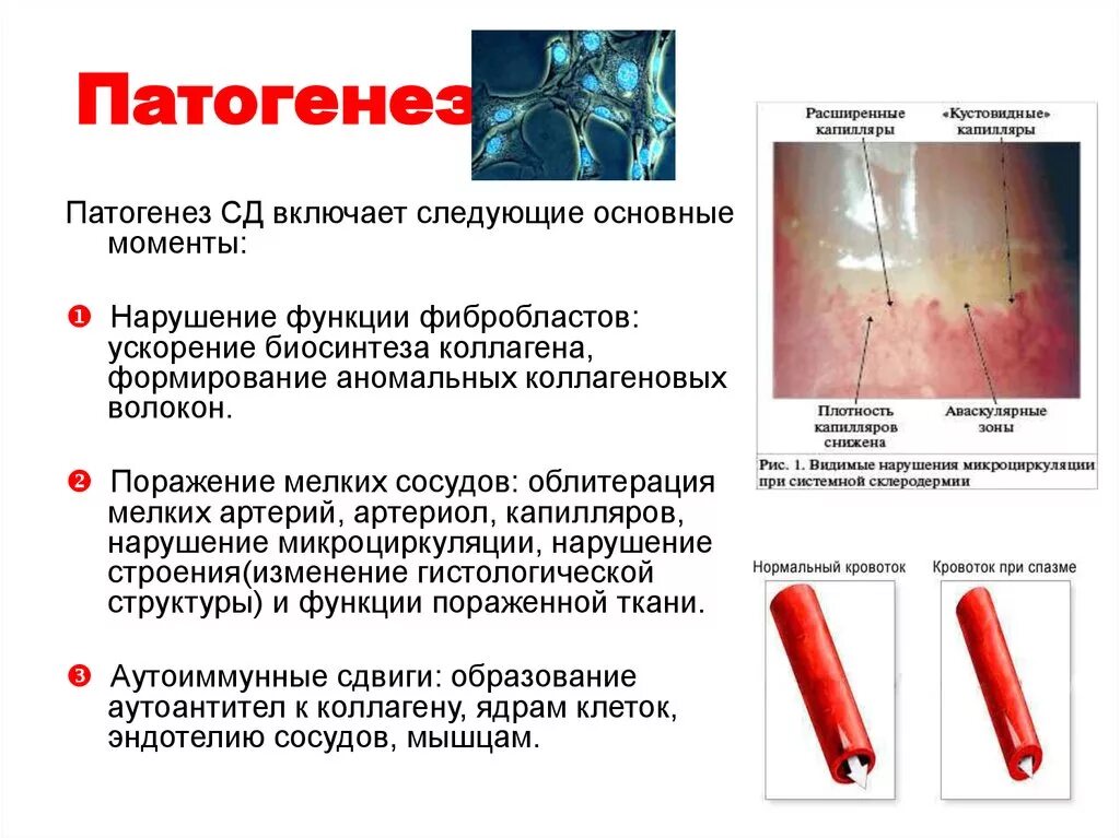 Склеродермия этиология. Системный склероз патогенез. Системная склеродермия патогенез. Склеродермия факторы риска. Системная склеродермия этиология патогенез.