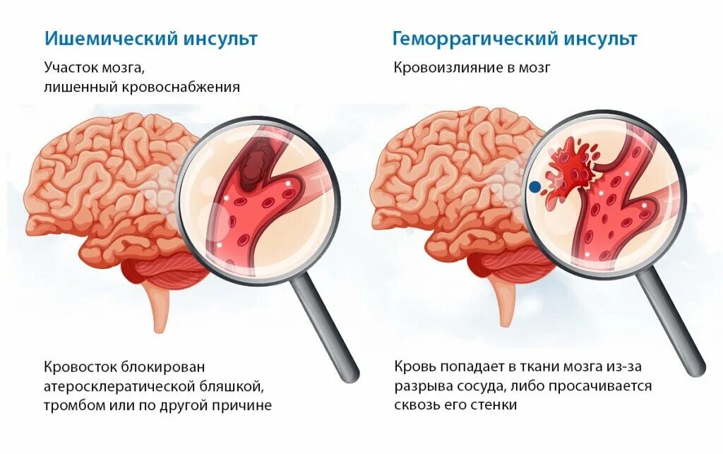 Заболевания ишемического инсульта. ОНМК геморрагический инсульт. Ишемический инсульт геморрагический инсульт схема. Острая стадия геморрагического инсульта. Ишемический инсульт схема мозга.