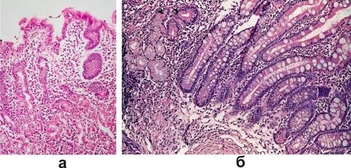 Атрофический гастрит гистология. Хронический гастрит гистология. Хронический атрофический гастрит. Признаки атрофией слизистой оболочки