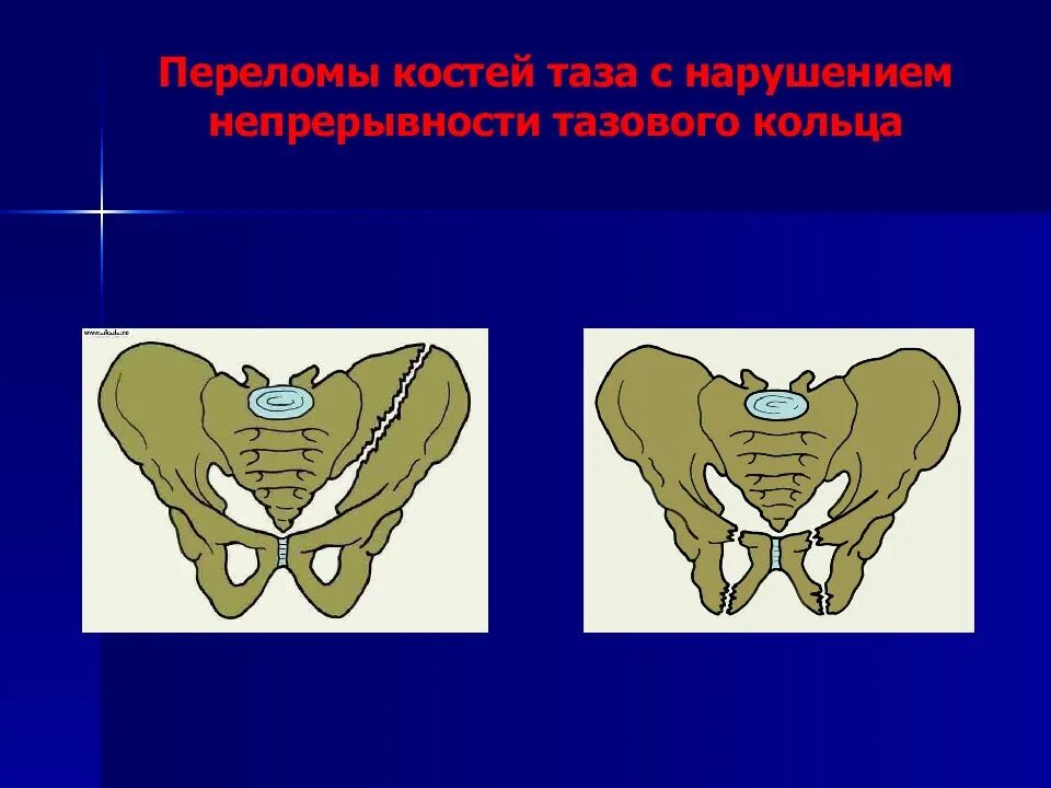 Переломы костей таза с нарушением непрерывности тазового кольца. Перелом костей таза с нарушением целостности тазового кольца. Переломы с нарушением непрерывности тазового кольца. Нарушение целостности тазового кольца.