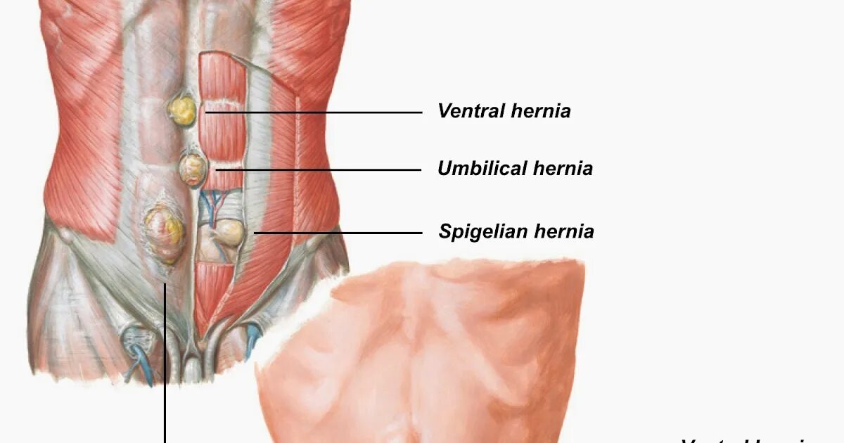 Грыжа спигелевой линии. Грыжа спигелиевой линии живота. Грыжа спигелиевой линии симптомы.