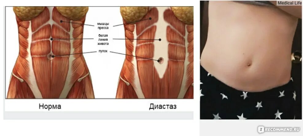 Прямые мышцы живота у мужчин. Диастаз брюшной полости.