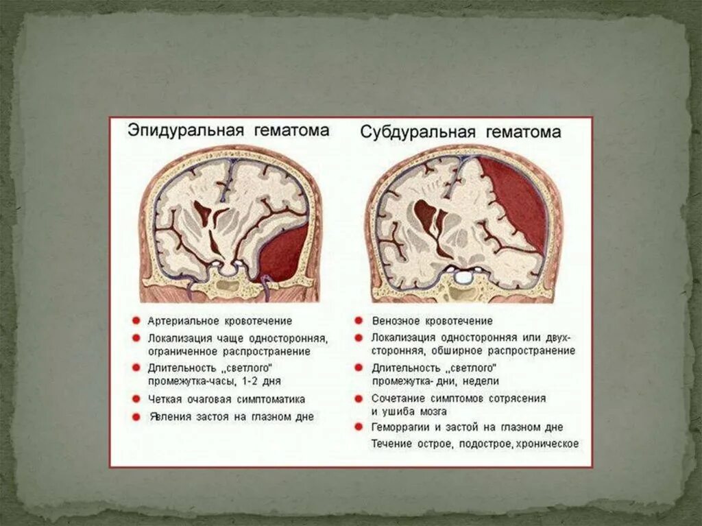 Эпидуральные и субдуральные гематомы. Клиника субдуральной и эпидуральной гематомы. Субдуральная и эпидуральная гематома кт. Эпидуральная гематома на кт. Субдуральная гематома лечение