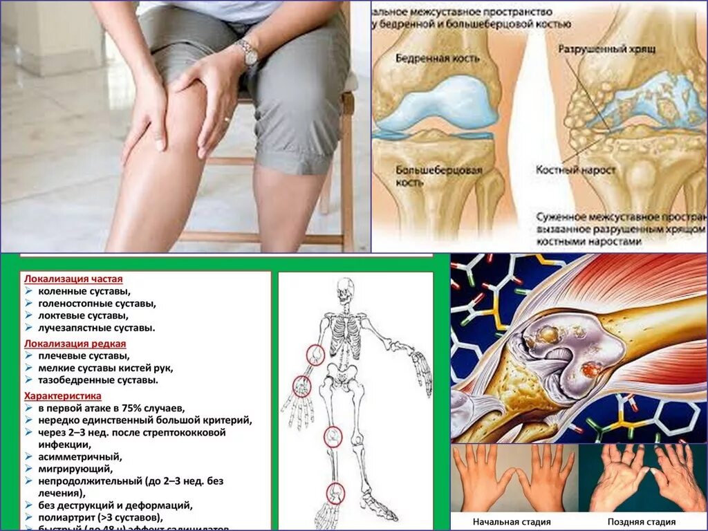Ревматоидный артрит симптомы сустава. Ревматизм поражение суставов. Поражение суставов при ревматизме. Изменения в области сустава ревматический артрит. Изменение формы сустава