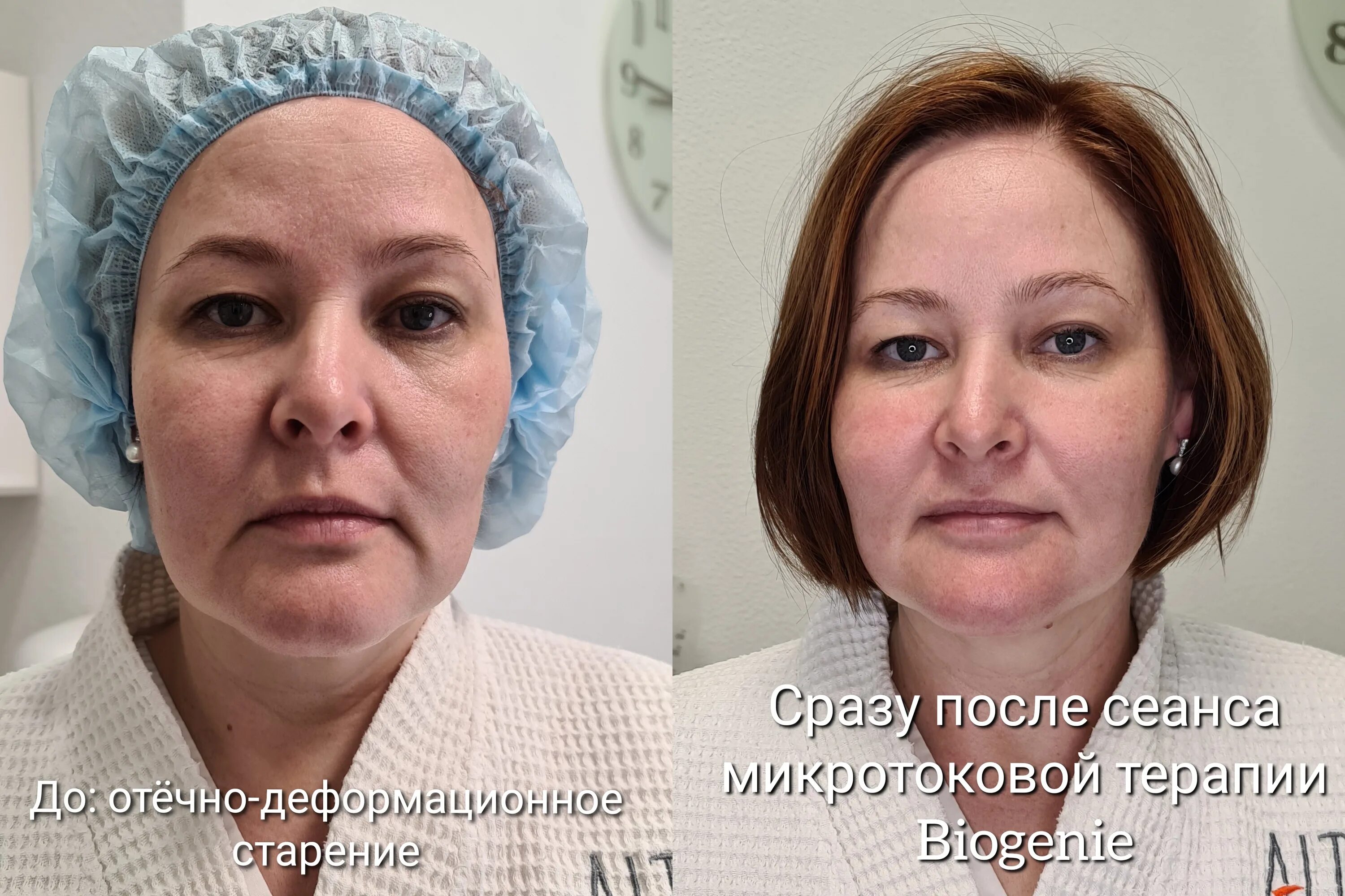 Микротоки лицо до и после фото отзывы. Микротоки биожени. микротоки для лица lj b gjckt. микротоки для лица до и после. биожени процедура для лица.