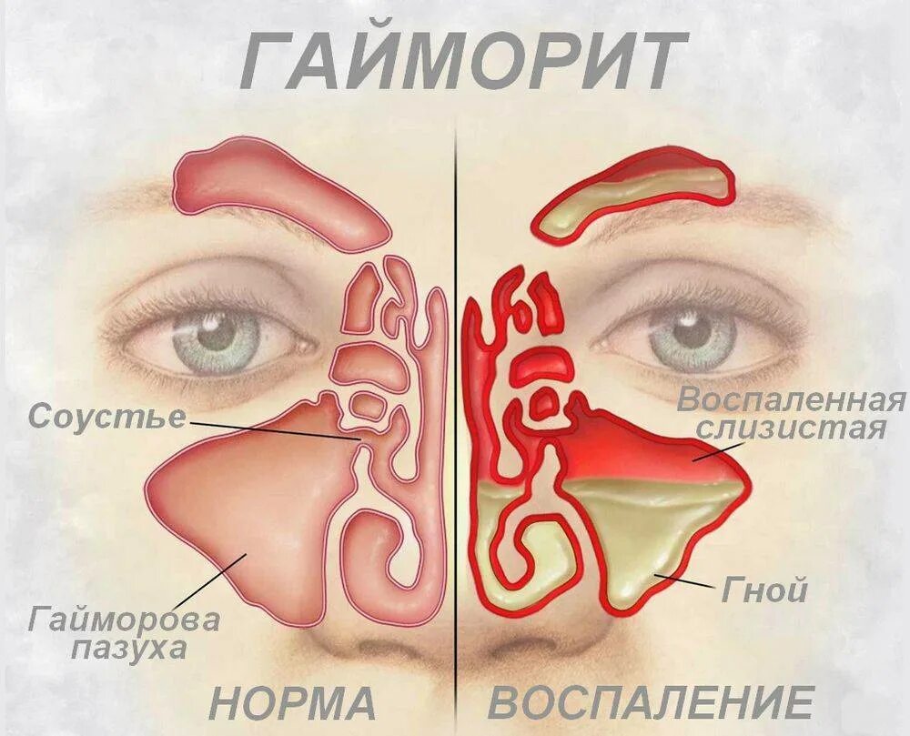 Гайморит симптомы чем лечить