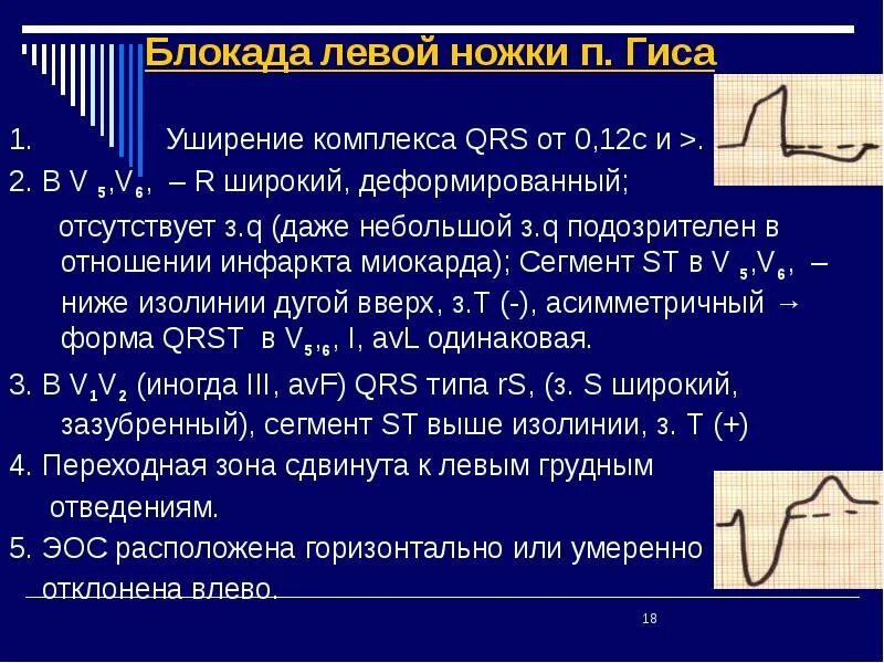 Замедление проведения по правой ножке пучка. Экг признаки нарушения внутрижелудочковой проводимости. нарушение проводимости пучка гиса на экг. нарушение проводимости блокады экг. экг при нарушении проводимости (блокады).