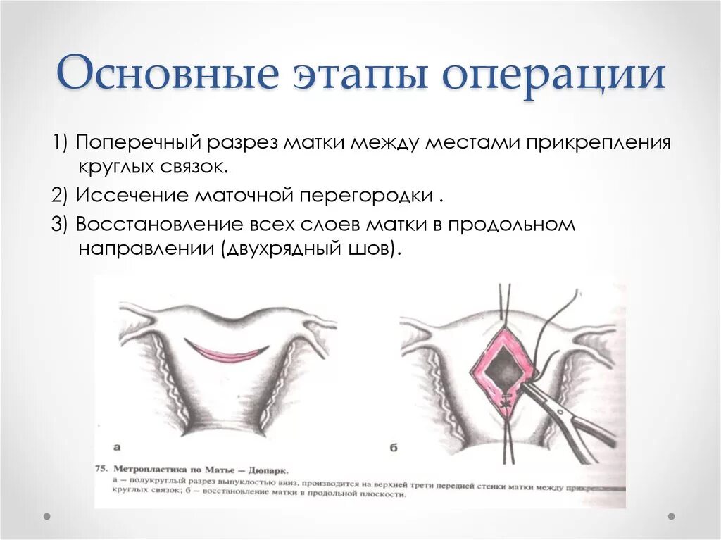 Операция по подтяжке матки. Метропластика Штрассмана. Основные этапы операции. Стандартные этапы операции. Основные этапы хирургии.