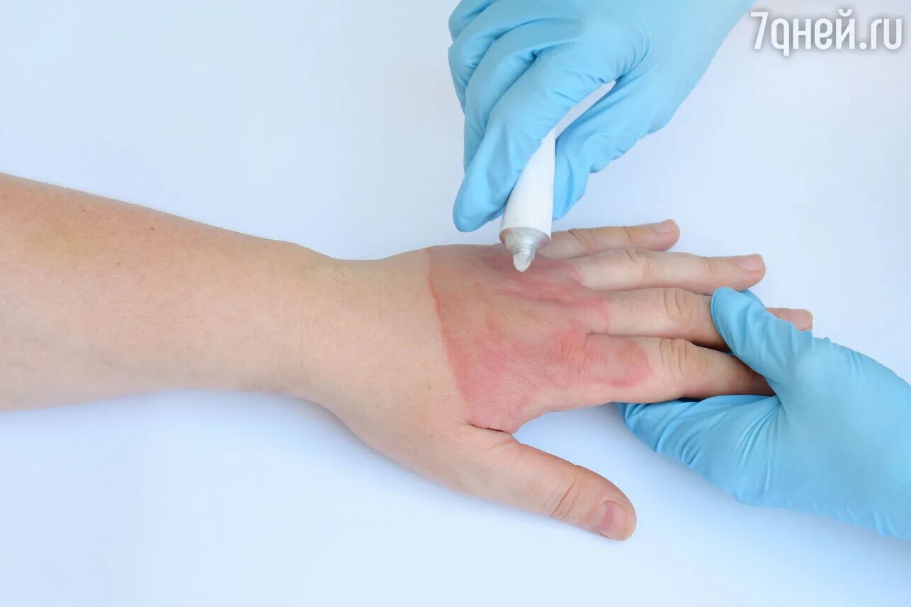 Средства при термических ожогах. От ожогов в домашних условиях средство. Что нанести на ожог. Что делать ть при ожоге. Первая помощьтприожогах.