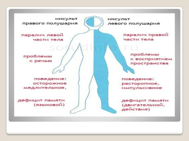 Левая сторона инсульта сколько живут. Инсульт правого полушария. Инсульт левая сторона. Инсульт ишемический правая сторона последствия. Паралич левой стороны тела.