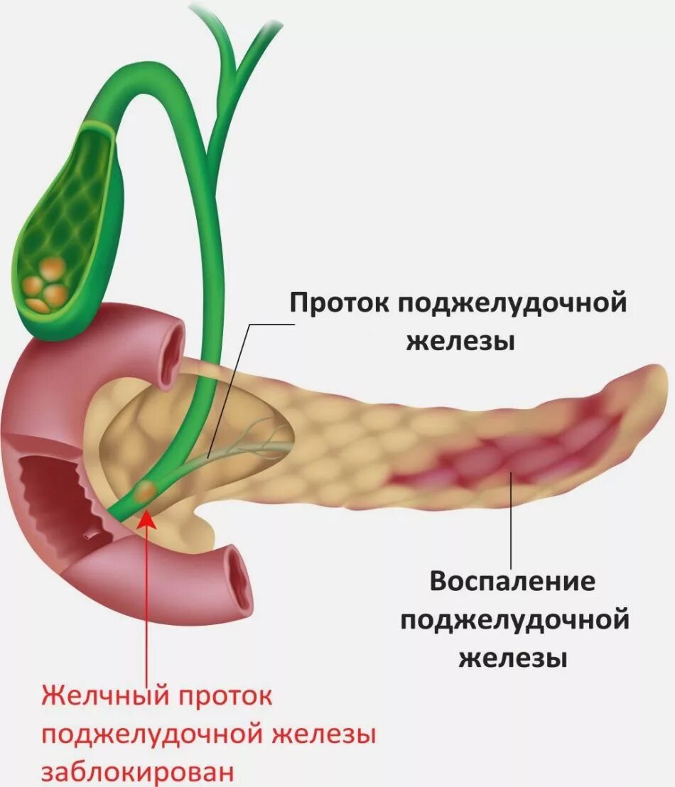 Минеральную воду при поджелудочной железе. Острый панкреатит поджелудочной железы. Хронический билиарный панкреатит. Хронический билиарнозависимый панкреатит. Желчный проток и проток поджелудочной.