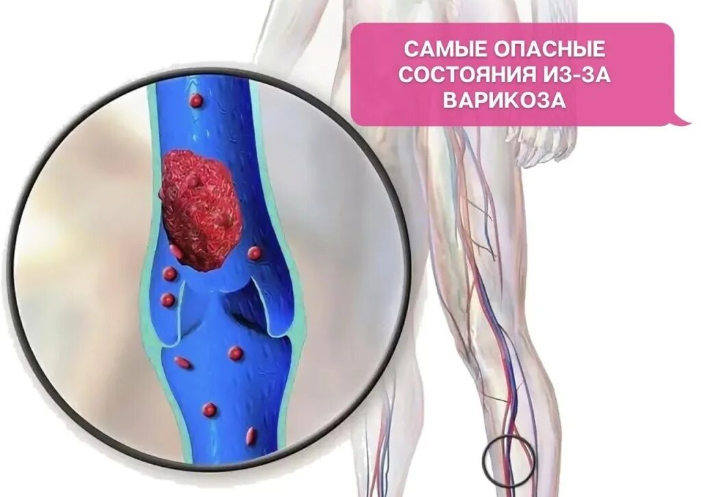 Венозный застой крови. Острый тромбофлебит вен нижних конечностей. Флебит тромбофлебит флеботромбоз. Подострый тромбофлебит. Поверхностный флебит, тромбофлебит.