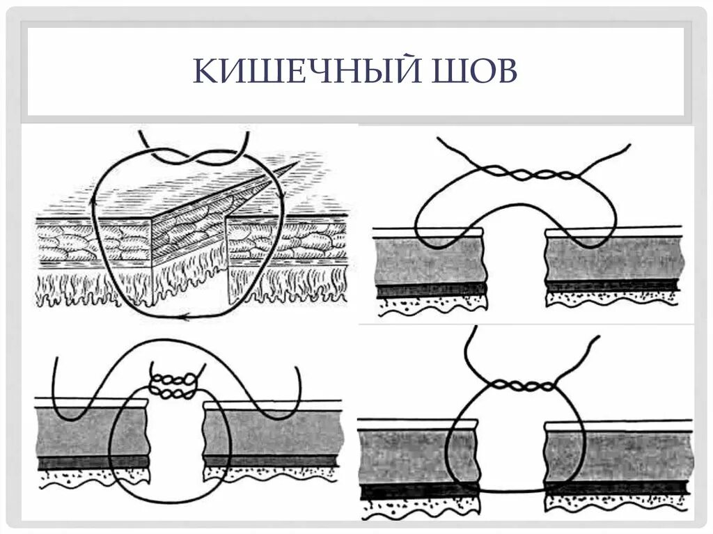 Стерильный шов. Кишечные швы хирургия шов Ламбера. Кишечный шов Ламбера схема. Кишечные швы Ламбера и Шмидена. Кишечный хирургический шов Шмидена.