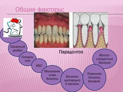 Пародонтоз лечение домашними средствами