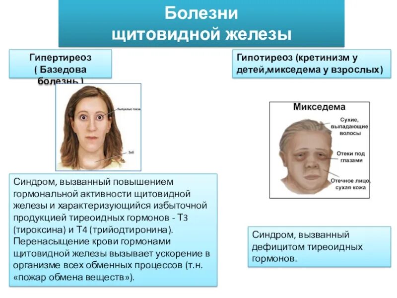 Болезни щитовидной железы у детей
