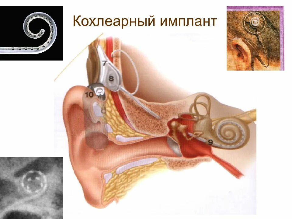 Операция на ухо на слух. Тугоухость кохлеарная имплантация. Нейросенсорная тугоухость имплантация кохлеарная. Кохлеарный отосклероз. Отосклероз слуховой аппарат.