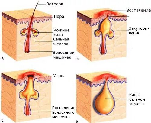 Сальные железы на лице как выглядит Симптомы и лечение анке (угревая сыпь), лечение угревой сыпи на лице.