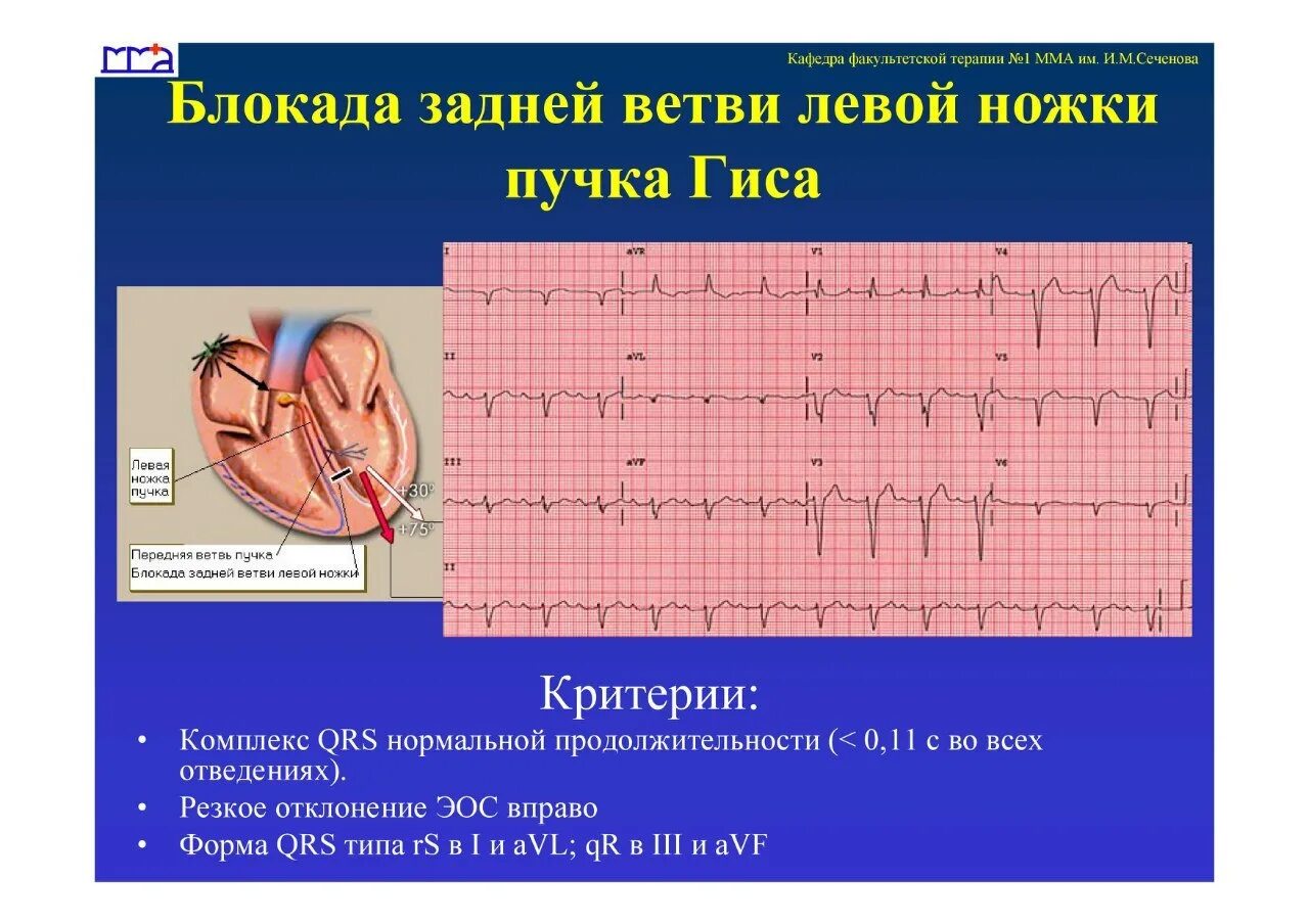 Блокада левой задней ножки. Блокада задней ветви ЛНПГ на ЭКГ. Блокада задней ветви левой ножки пучка Гиса на ЭКГ. Блокада левой задней ветви пучка Гиса. Блокада задней левой ветви п.Гиса.