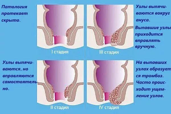 Ванночки с марганцовкой при геморрое. Стадии развития геморроя.