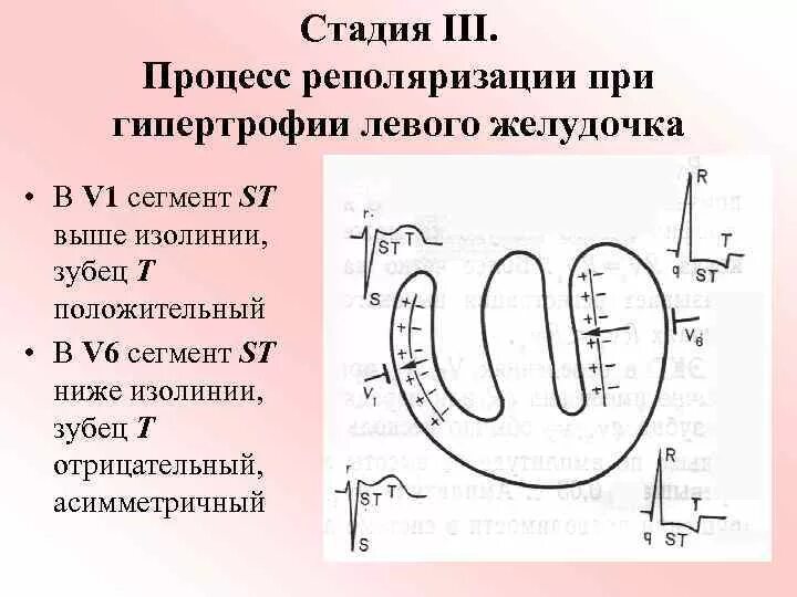 Реполяризация миокарда желудочков ЭКГ. Нарушение реполяризации миокарда на ЭКГ. Реполяризация миокарда на ЭКГ. Нарушение процесса реполяризации по стенке левого желудочка. Диффузная реполяризации левого желудочка