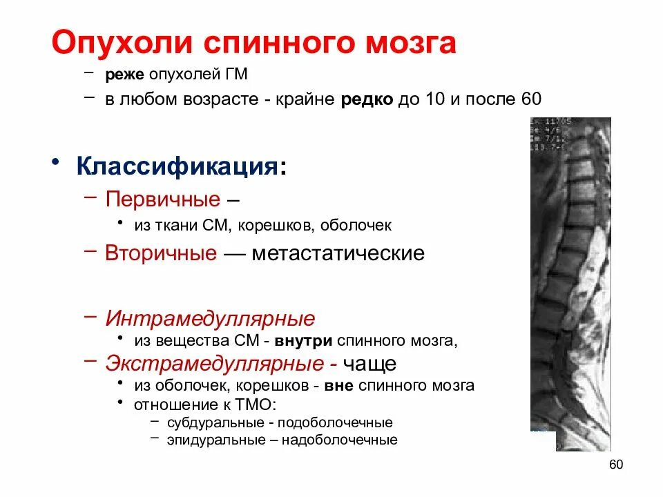 Рак позвоночника симптомы и признаки поясничного отдела