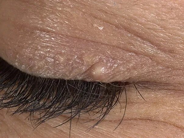 Have a Lump on Your Eye? Here's What It Could Mean TipHero