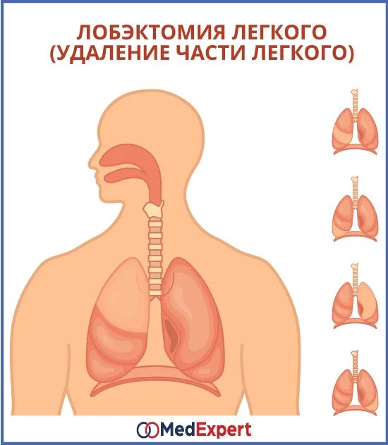 восстанавливаются легкие после удаления легких