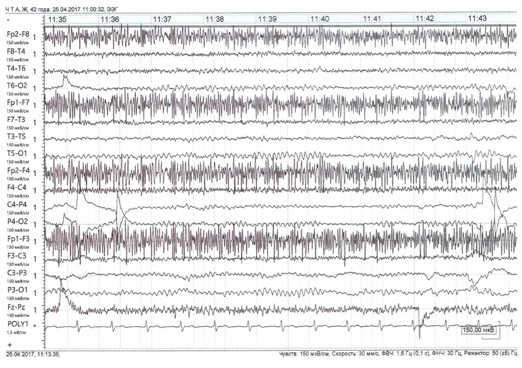 Пароксизмальная ээг. Изменения ЭЭГ при эпилепсии. Эпилептическая активность на ЭЭГ. Приступ эпилепсии на ЭЭГ. Мультифокальная эпилепсия ЭЭГ.