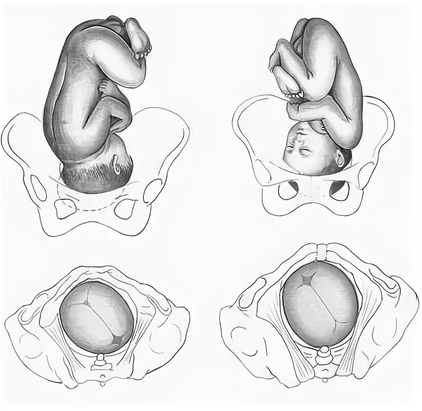 Головное предлежание 2 позиция передний вид. Продольное головное предлежание 2 позиция. Головное предлежание плода 2 позиция. Продольное головное предлежание плода 2 позиция передний вид. Первое положение плода