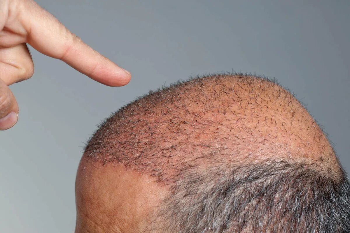 Выпадение волос после пересадки волос. Лысина у мужчин. Появление волосяного покрова