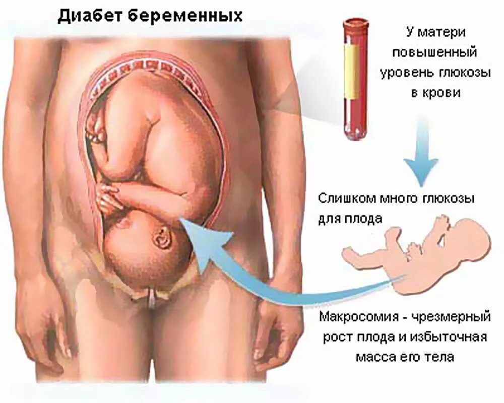 Диабет после беременности. Норма сахара у беременных в 3 триместре. Сахар в крови норма у женщин при беременности. Сахар в крови норма при беременности 1 триместр. Гестационный сахарный диабет у беременных.