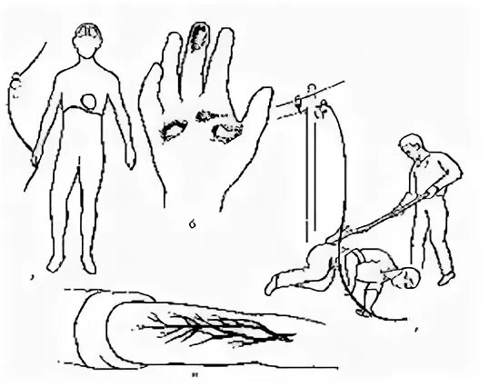 Местные проявления электротравмы. Термическая электротравма. Электротравма ожог рисунок.