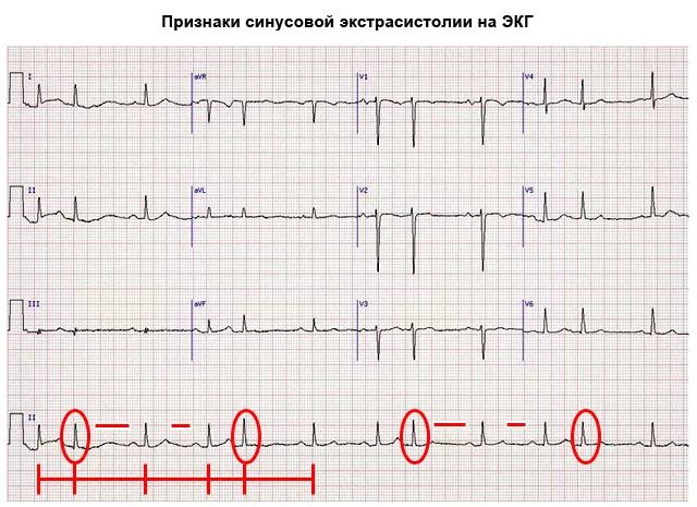 Синусовые экстрасистолы