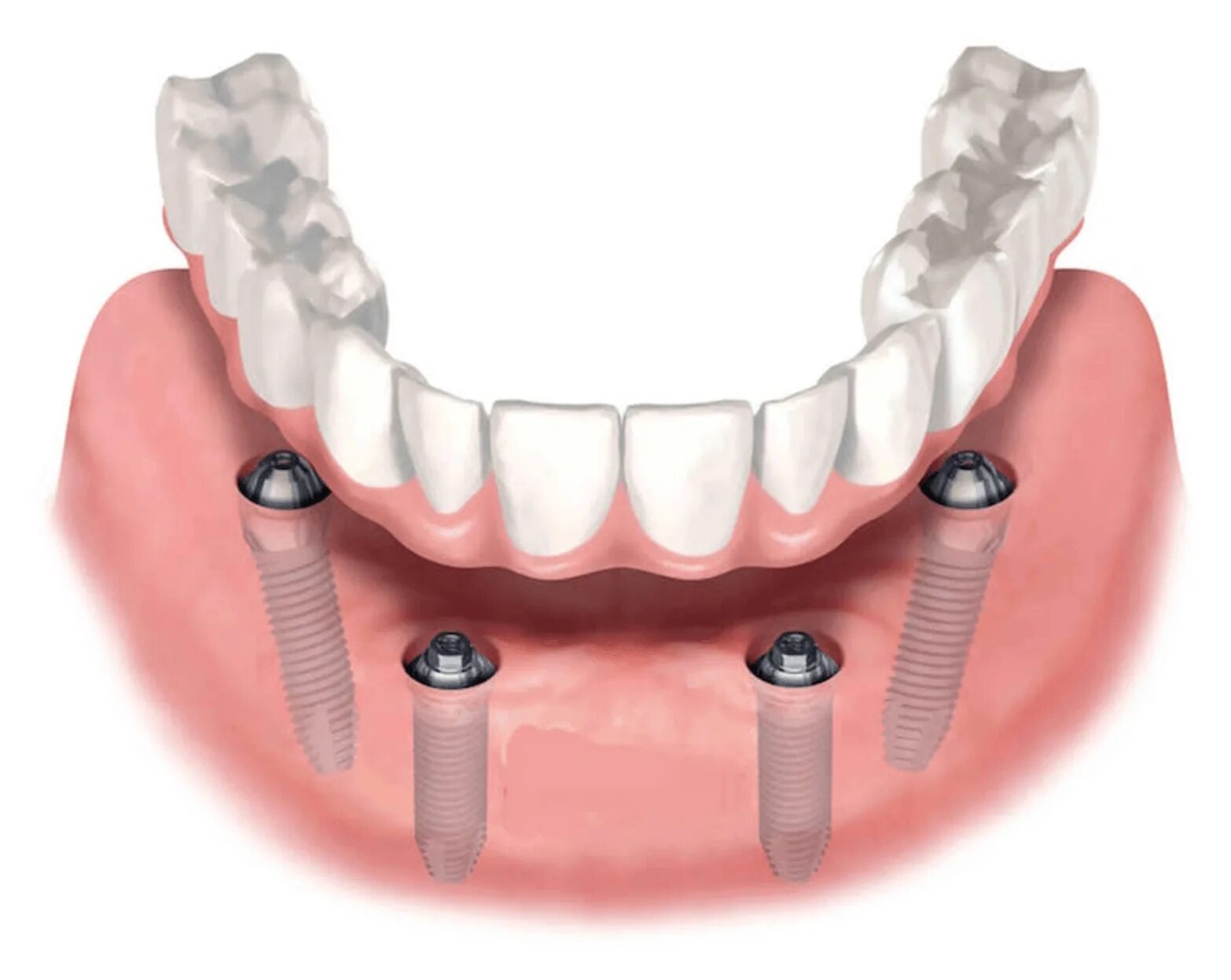 Имплантологическая кассета Nobel полный набор для all on 4. Имплантация Neodent. Мостовидный протез на имплантах на 4 зуба нижней челюсти.