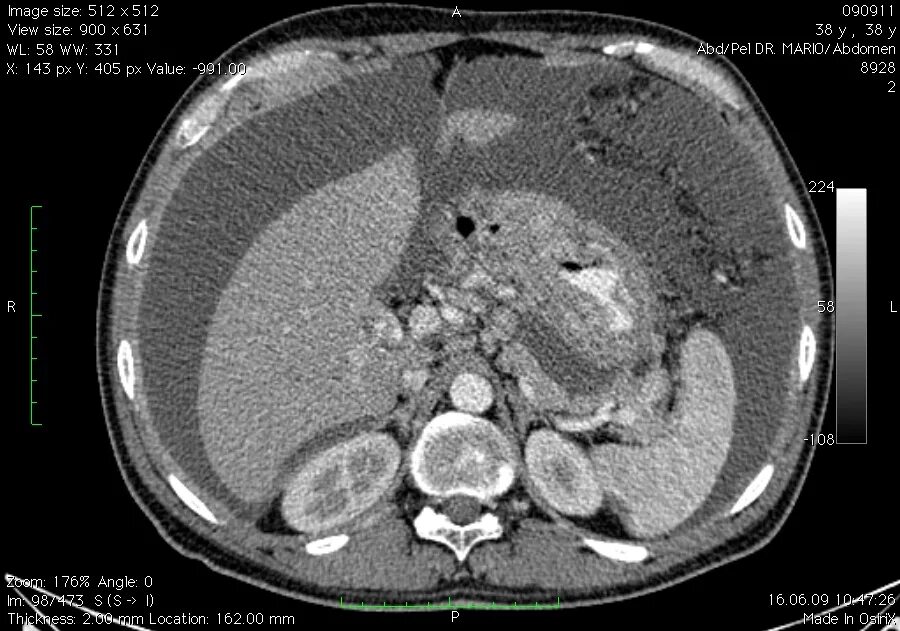 Перитонеальный канцероматоз кт. Перитонеальный канцероматоз брюшины. Канцероматоз брюшины кт. Канцероматоз брюшины кт. Канцероматоз сальника на кт.