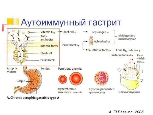 Хронический аутоиммунный гастрит патогенез. Аутоиммунный гастрит патогенез. Хронический гастрит типа а аутоиммунный. Аутоиммунный атрофический гастрит патогенез. Аутоиммунный гастрит клинические