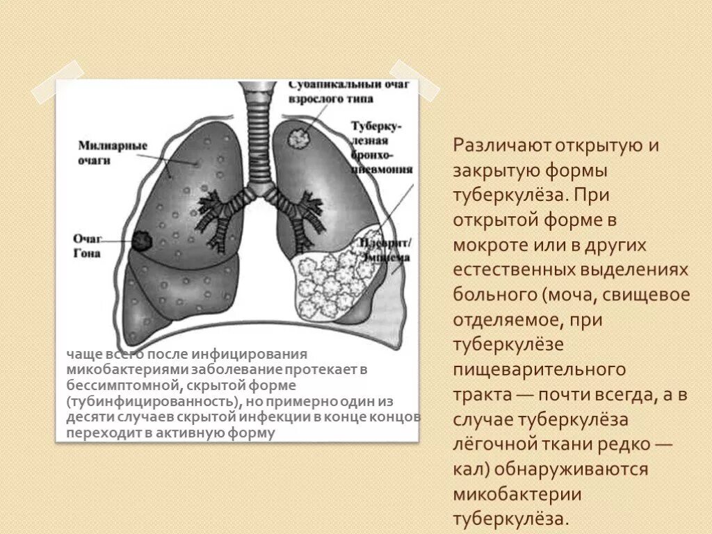 Неактивный туберкулез. Закрытая форма туберкулеза. Открытые формы туберкулеза. Открытая и закрытая форма туберкулеза. Туберкулёз открытой формы.