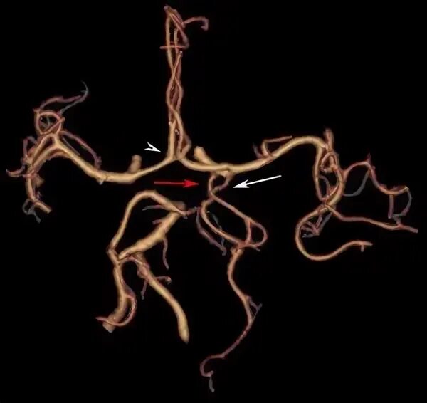 Правая задняя трифуркация. Задняя трифуркация внутренней сонной артерии мрт. Двусторонняя задняя трифуркация. Передняя трифуркация ВСА мрт. Передняя трифуркация передней мозговой артерии.