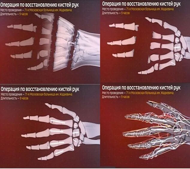 Операция по восстановлению кисти. Операция по уменьшению кистей рук. Реабилитация кисти после операции