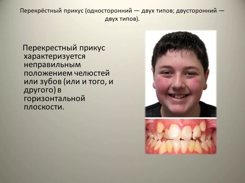 Перекрестные зубы