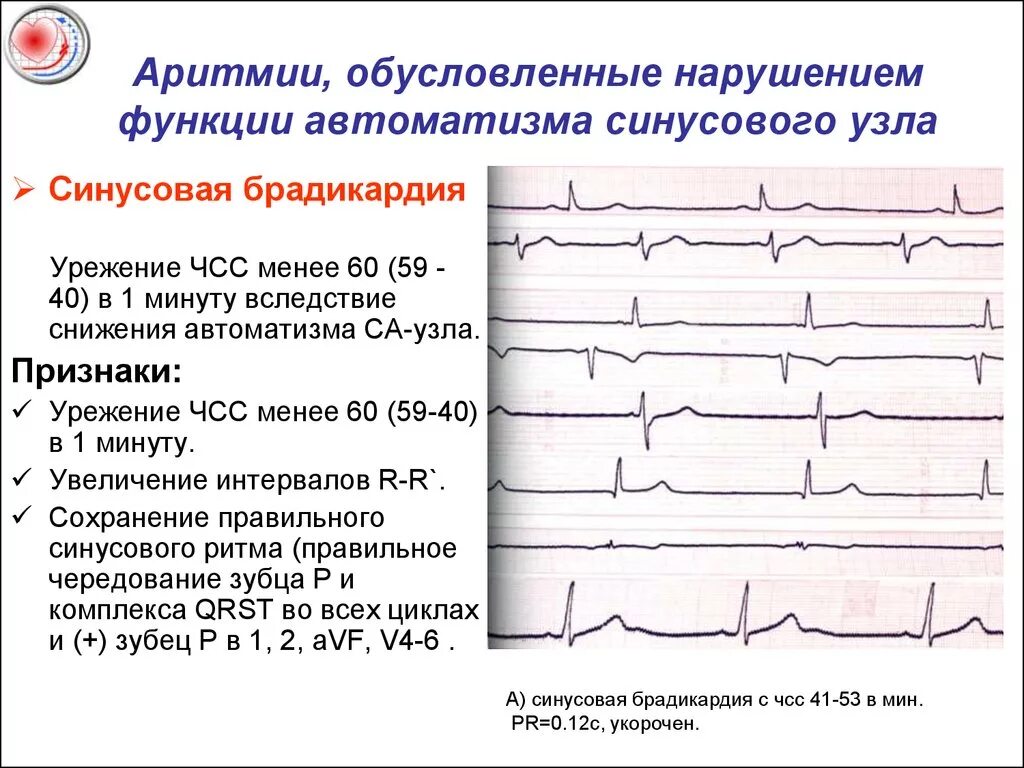 ЭКГ брадикардия синусовый ритм. Синусовая Мерцательная аритмия ЭКГ. Синусовая брадикардия на ЭКГ. Нарушение функции АВТОМАТИЗМА сердца на ЭКГ.