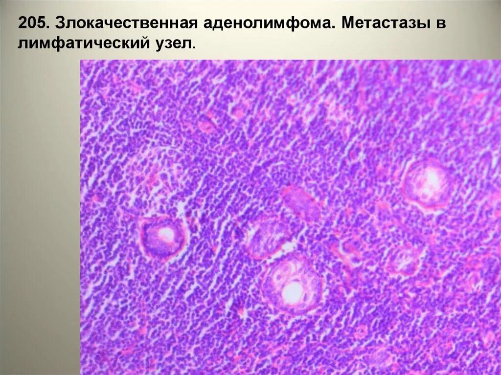 Метастазированные лимфоузлы. Аденолимфома гистология. Метастаз в лимфоузел микропрепарат. Метастазы в лимфоузлах микропрепарат. Метастаз меланомы в лимфатический узел микропрепарат.